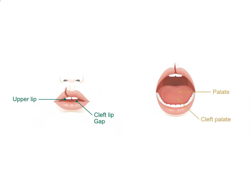 Labeled illustration: cleft lip and palate (CLP)