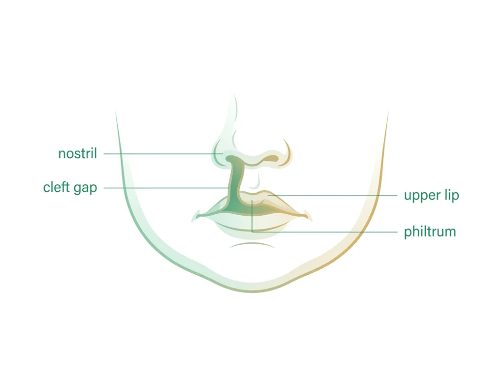 Labeled illustration: cleft lip (CL)