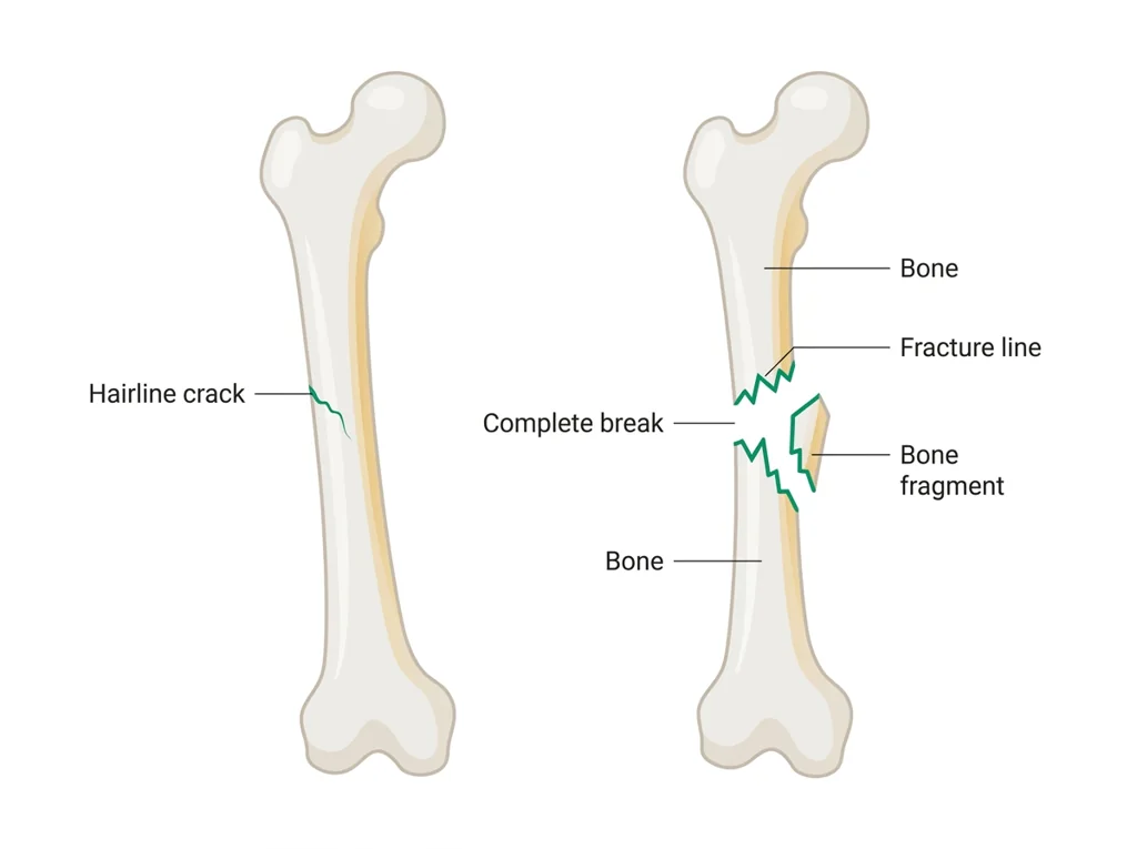 Labeled illustration: fracture