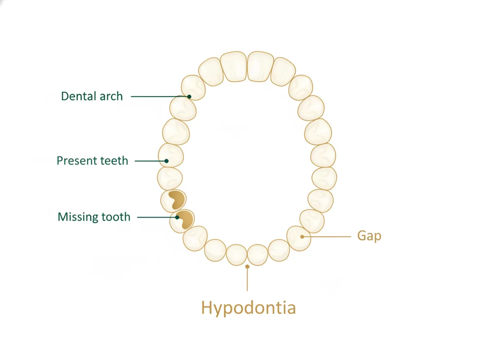 Labeled illustration: hypodontia