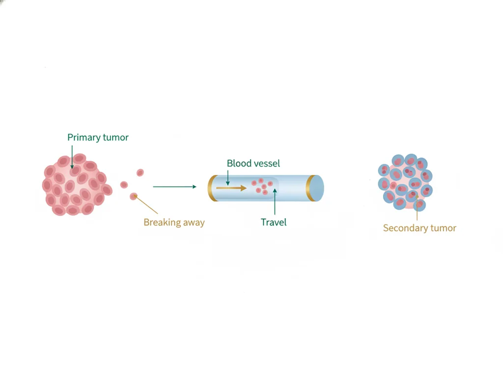 Labeled illustration: metastasis