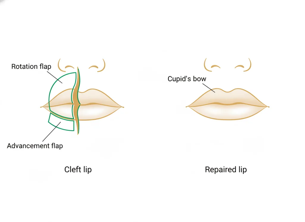Labeled illustration: rotation-advancement