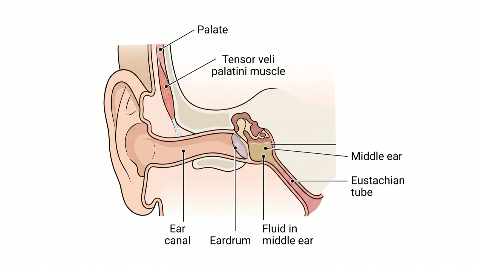 The link between a cleft palate and hearing: palate muscles that open the Eustachian tube, the tube connecting to the middle ear, and fluid building behind the eardrum.